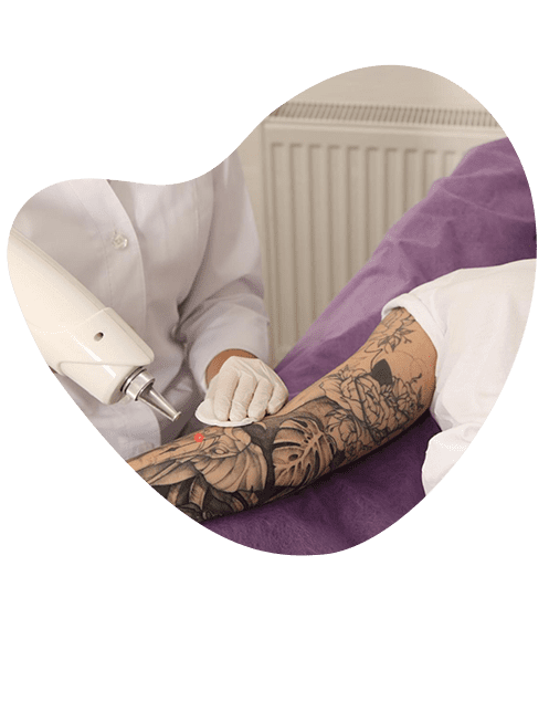 doctor-especializado-en-borrar-tatuajes.png