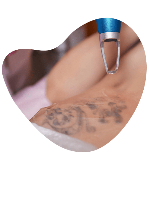 efectividad-en-borrado-de-tatuajes.png