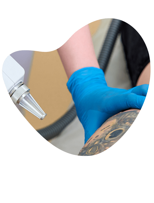 eliminacion-de-tatuajes-en-areas-dificiles.png
