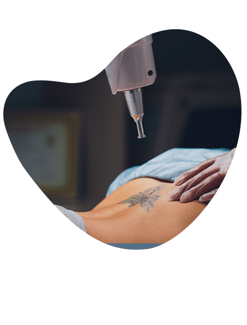 expertos-en-borrado-de-tatuajes-en-toluca.png