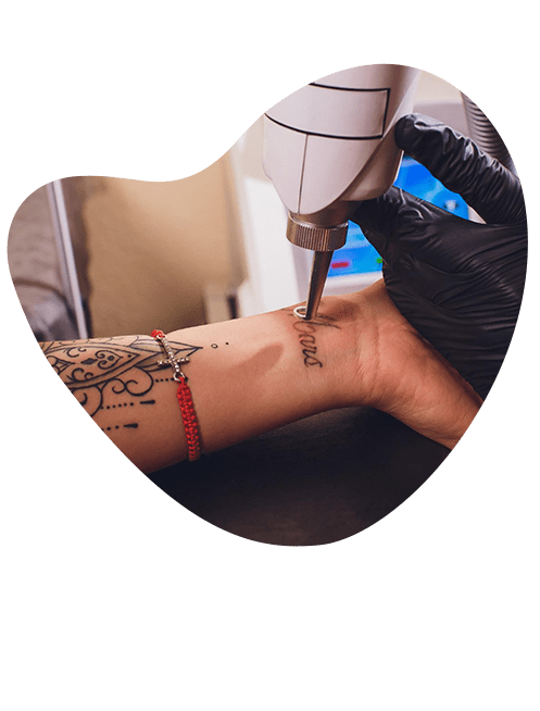remocion-de-tatuajes-a-largo-plazo.png