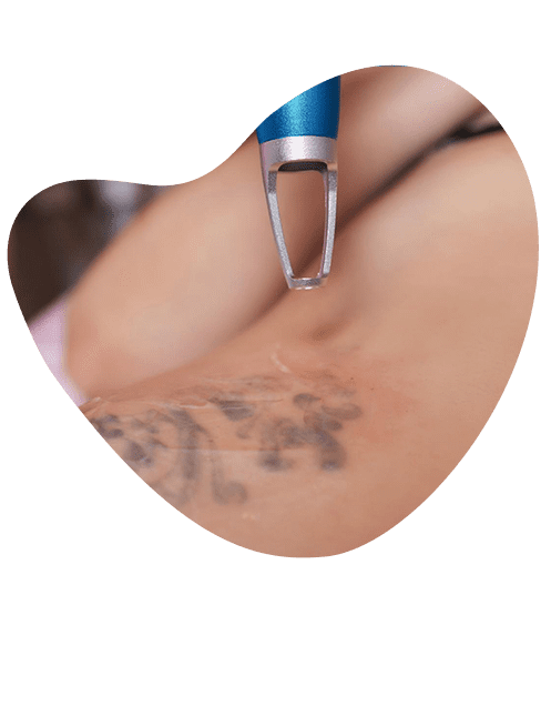 tecnicas-modernas-de-remocion-de-tatuajes.png