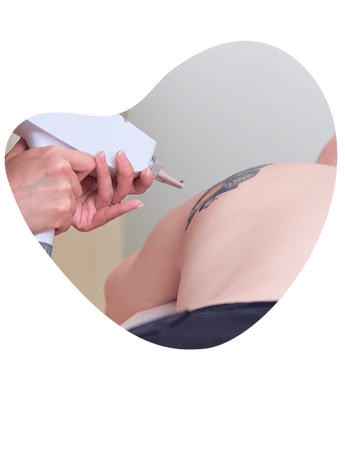 tecnologia-avanzada-en-borrado-de-tatuajes.png